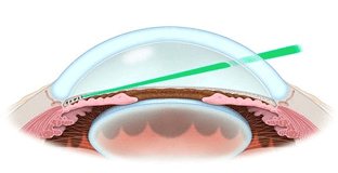 선택적 레이저 섬유주 성형술 — 비스듬한 초록 레이저가 섬유주를 조사