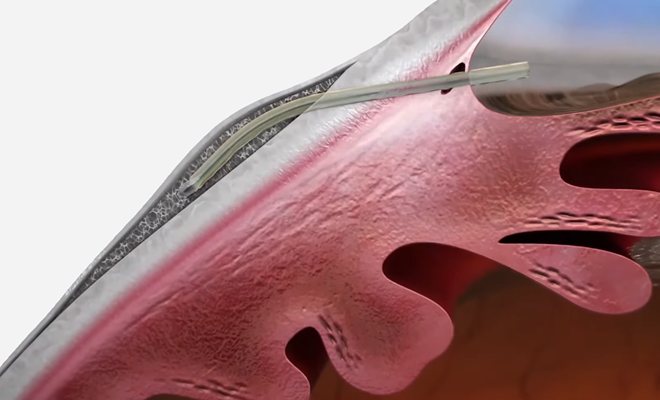 젠 마이크로 스텐트 — 결막 아래 공간으로 놓인 미세 스텐트 단면 일러스트
