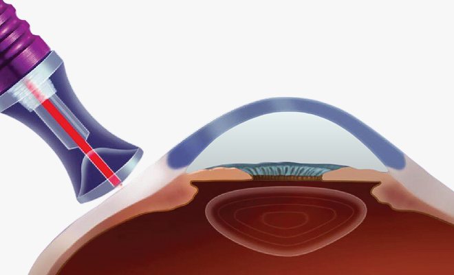 섬모양체 광응고술 — 레이저 프로브가 섬모체 쪽을 조사하는 눈 단면 일러스트